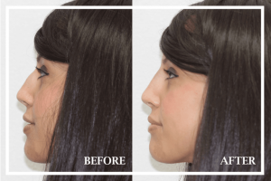 Non surgical nose job